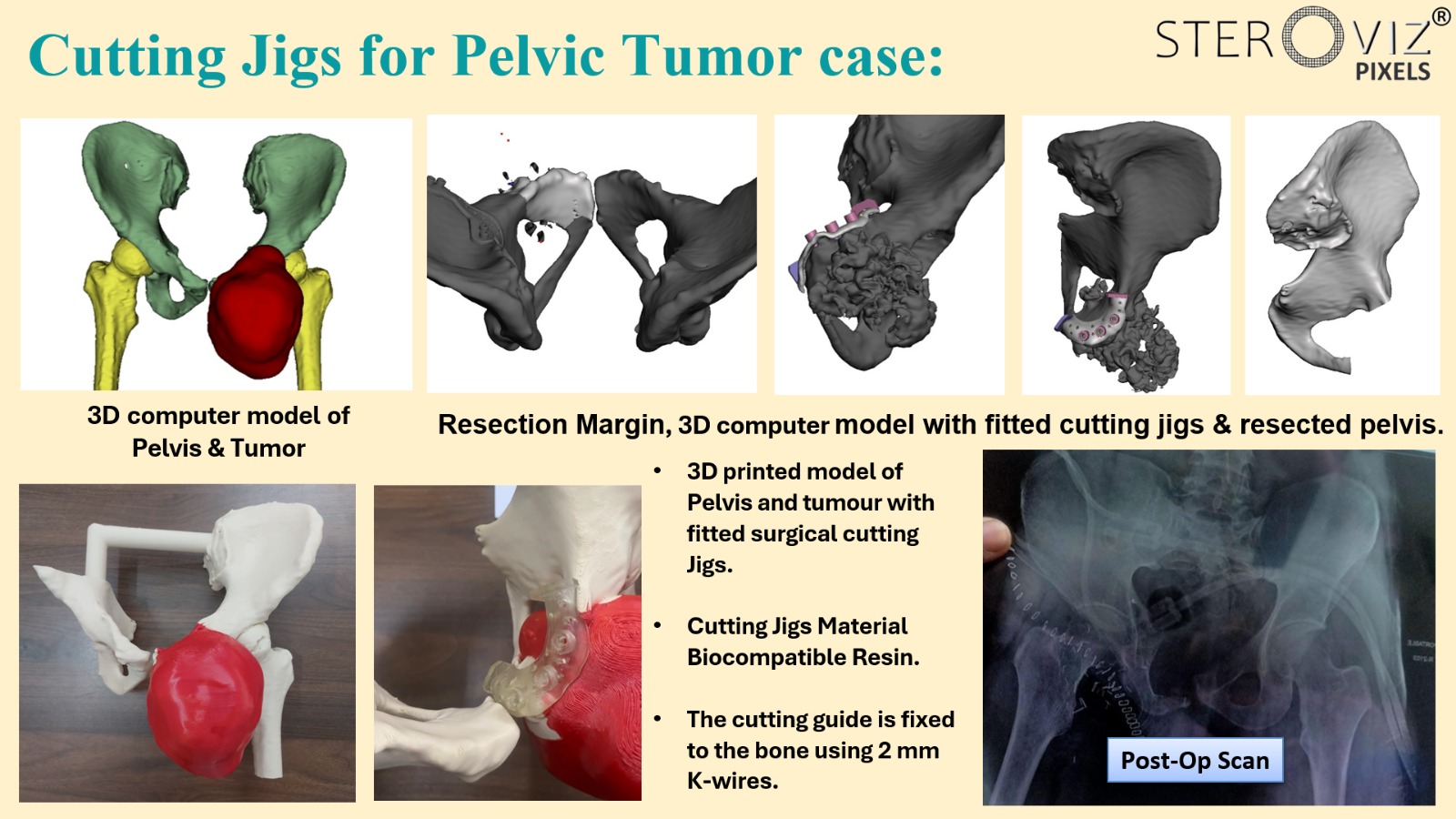Cutting Jigs and 3D Printed Anatomical Model for Pelvic Tumor
