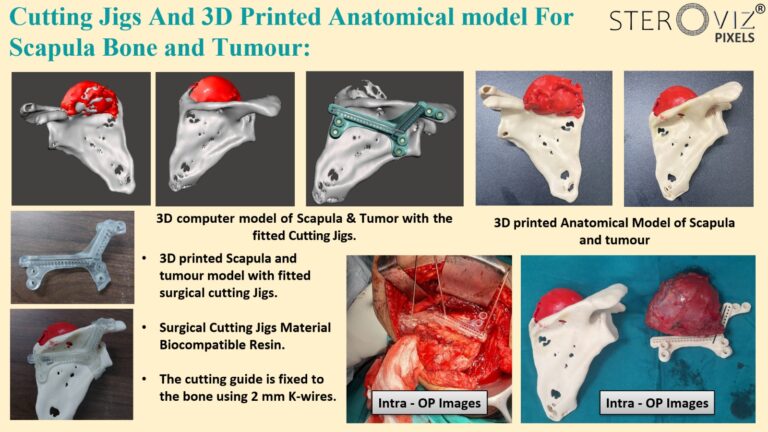Read more about the article Cutting Jigs and 3D Printed Anatomical Model of Scapula with Tumor