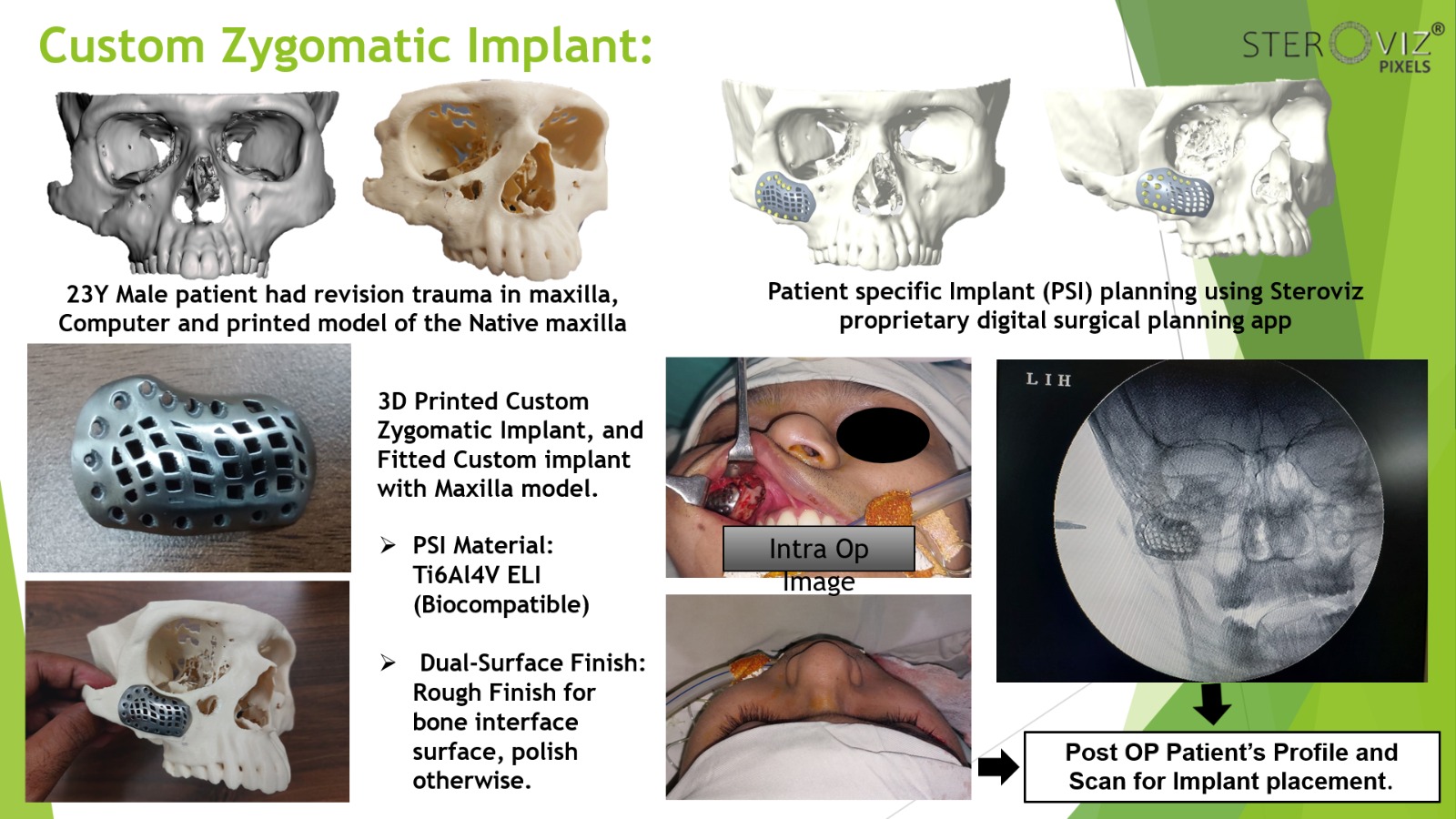 Custom Zygomatic implant