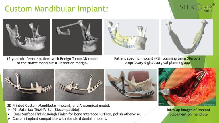 Read more about the article Custom Mandibular Implant