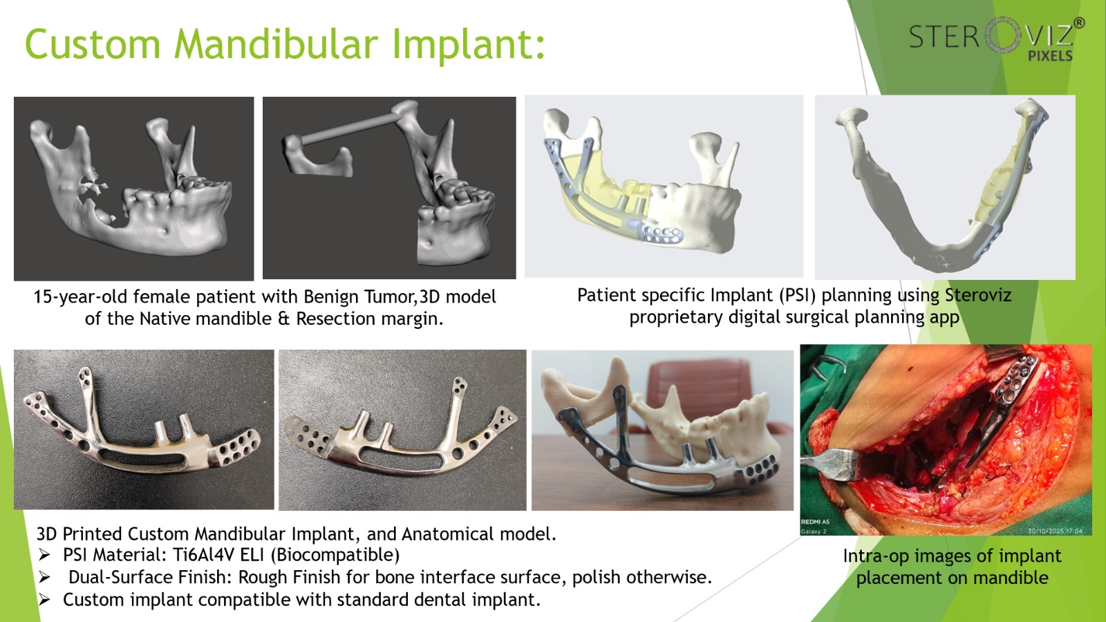 Custom Mandibular Implant