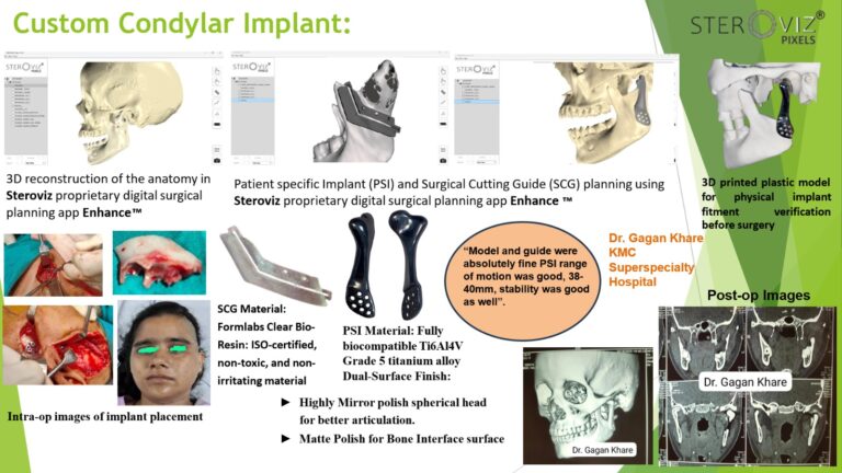 Read more about the article Custom Condylar Implant