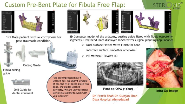 Read more about the article Digital Planning for Free Fibula Flap & Mandibular Pre-bent Plate