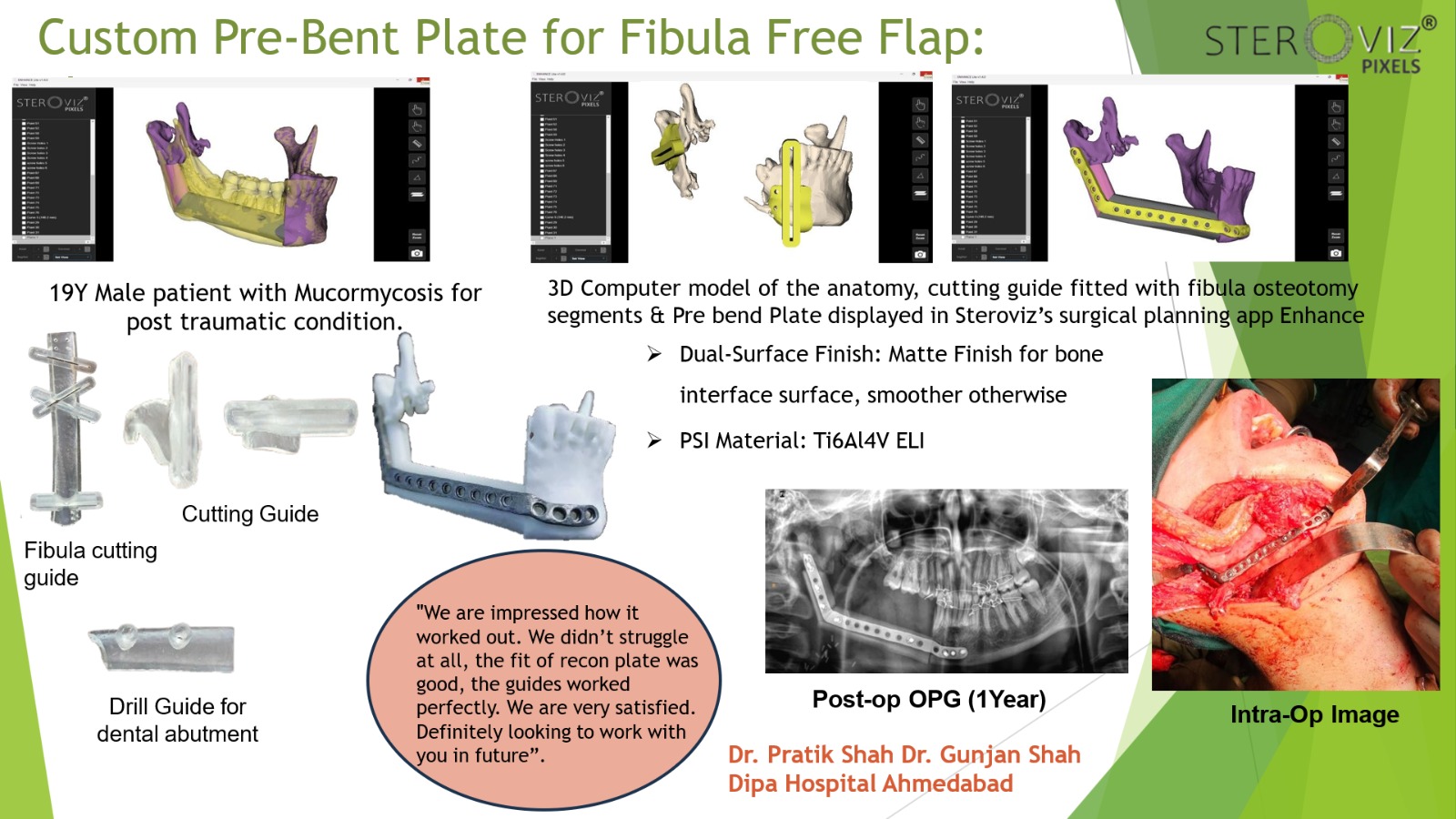 Digital Planning for Free Fibula Flap & Mandibular Pre-bent Plate