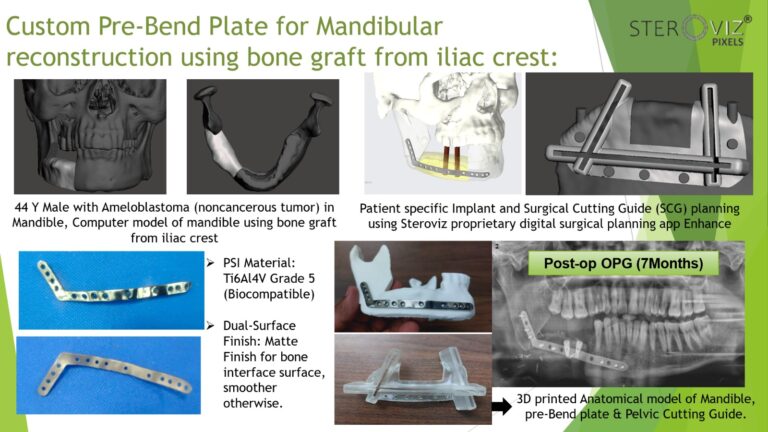 Read more about the article Digital Planning for Free Fibula Flap from Iliac Crest , Cutting Guide & Mandibular Pre-bent Plate