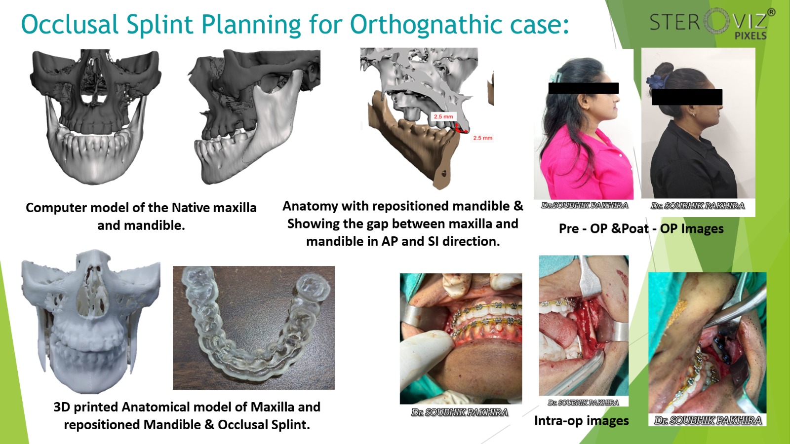 Orthognathic Planning & Occlusion Splint