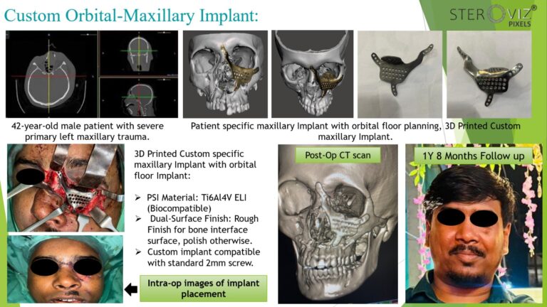 Read more about the article Custom Maxillary Orbital Implant