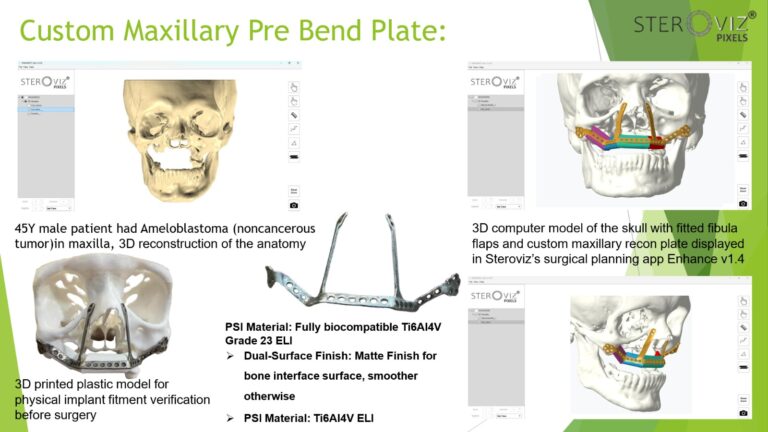 Read more about the article Free Fibula Flap Planning & Maxillary Pre-bent Plate