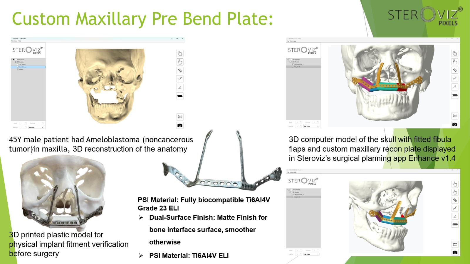 Free Fibula Flap Planning & Maxillary Pre-bent Plate