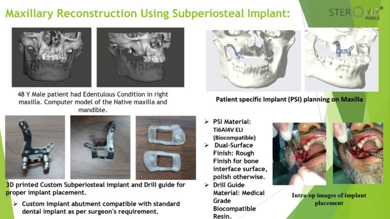 Read more about the article Custom Maxillary Subperiosteal Implant