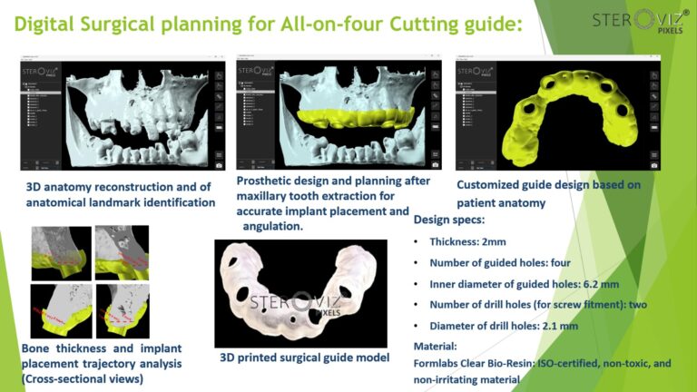 Read more about the article Surgical Cutting Guide All-on-Four Implant