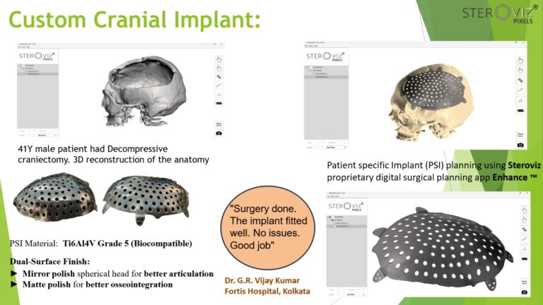 Read more about the article Custom Cranial Implant