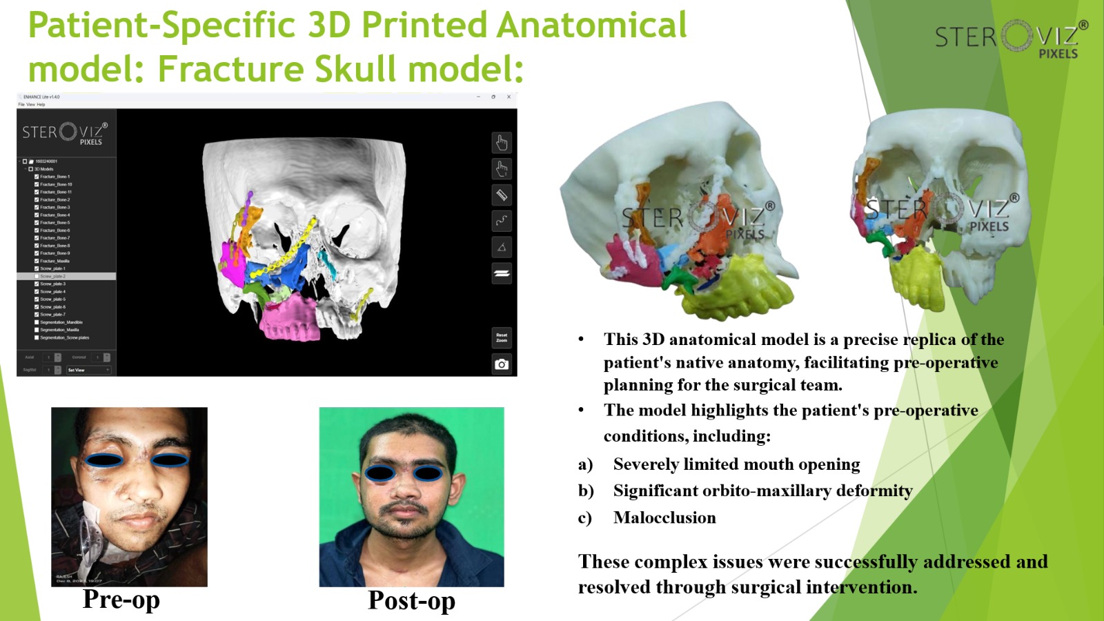 Anatomical Model for Revision Surgery Planning of Skull