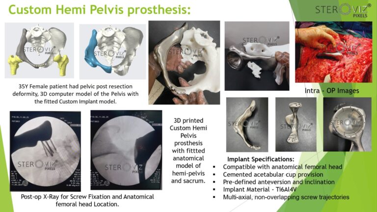 Read more about the article Custom Hemi-Pelvis Implant