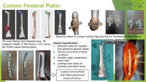 Read more about the article Custom Femoral Plate: