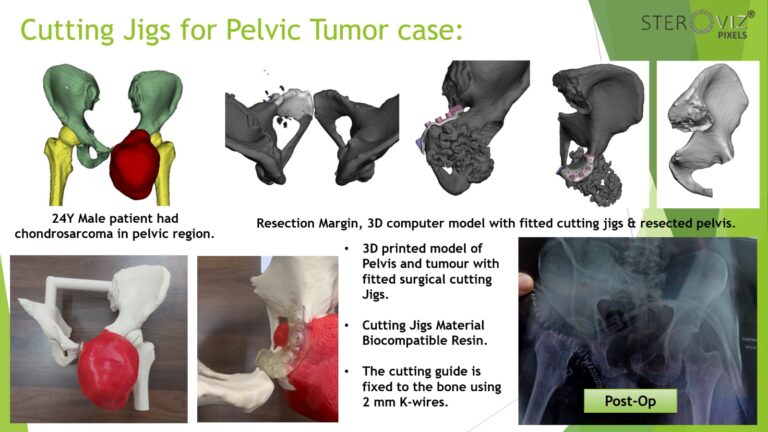 Read more about the article Cutting Jigs and 3D Printed Anatomical Model for Pelvic Tumor