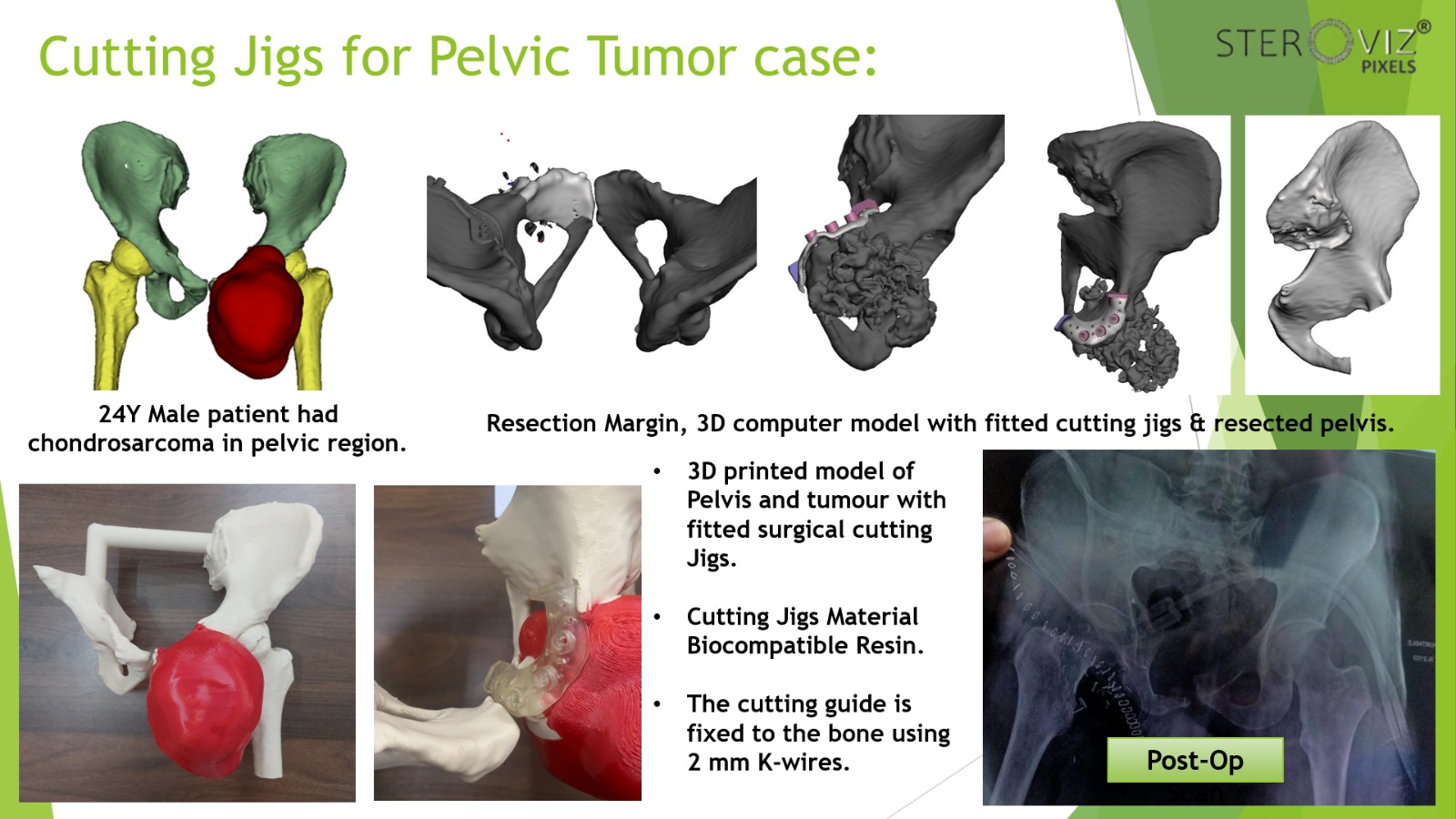 Cutting Jigs and 3D Printed Anatomical Model for Pelvic Tumor