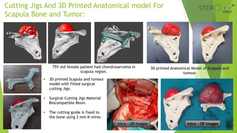 Read more about the article Cutting Jigs and 3D Printed Anatomical Model of Scapula with Tumor