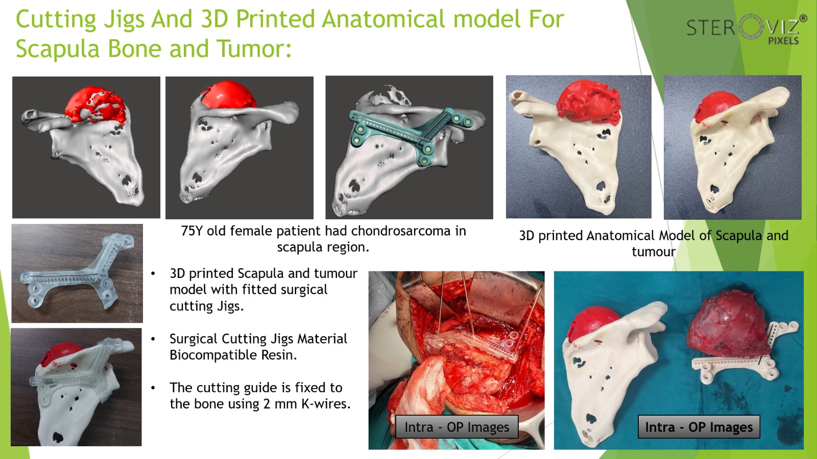Cutting Jigs and 3D Printed Anatomical Model of Scapula with Tumor