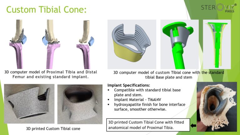 Read more about the article Custom Tibial Cone