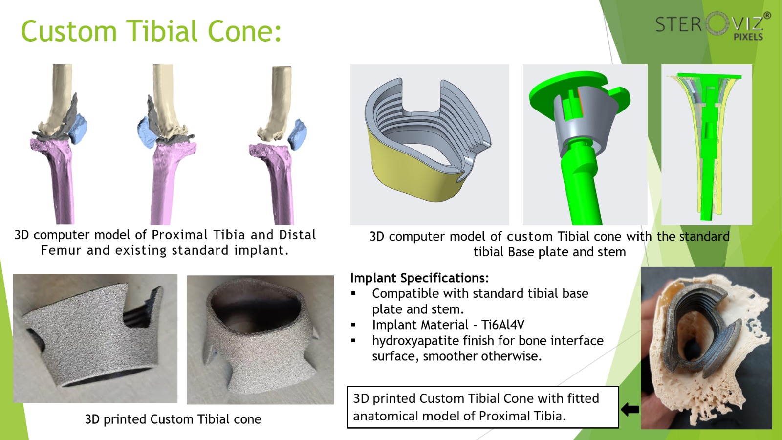 Custom Tibial Cone