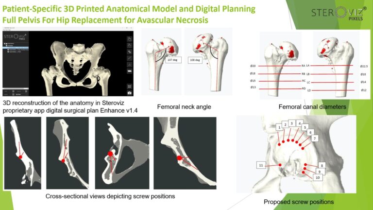 Read more about the article Digital Planning for Avascular Necrosis
