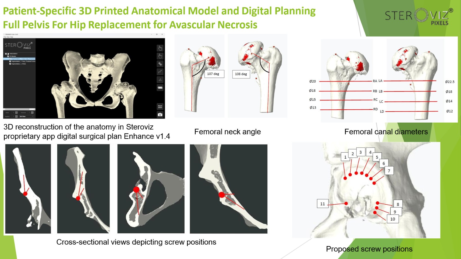 Digital Planning for Avascular Necrosis