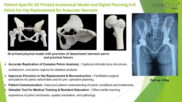 Read more about the article Anatomical Model for Avascular Necrosis