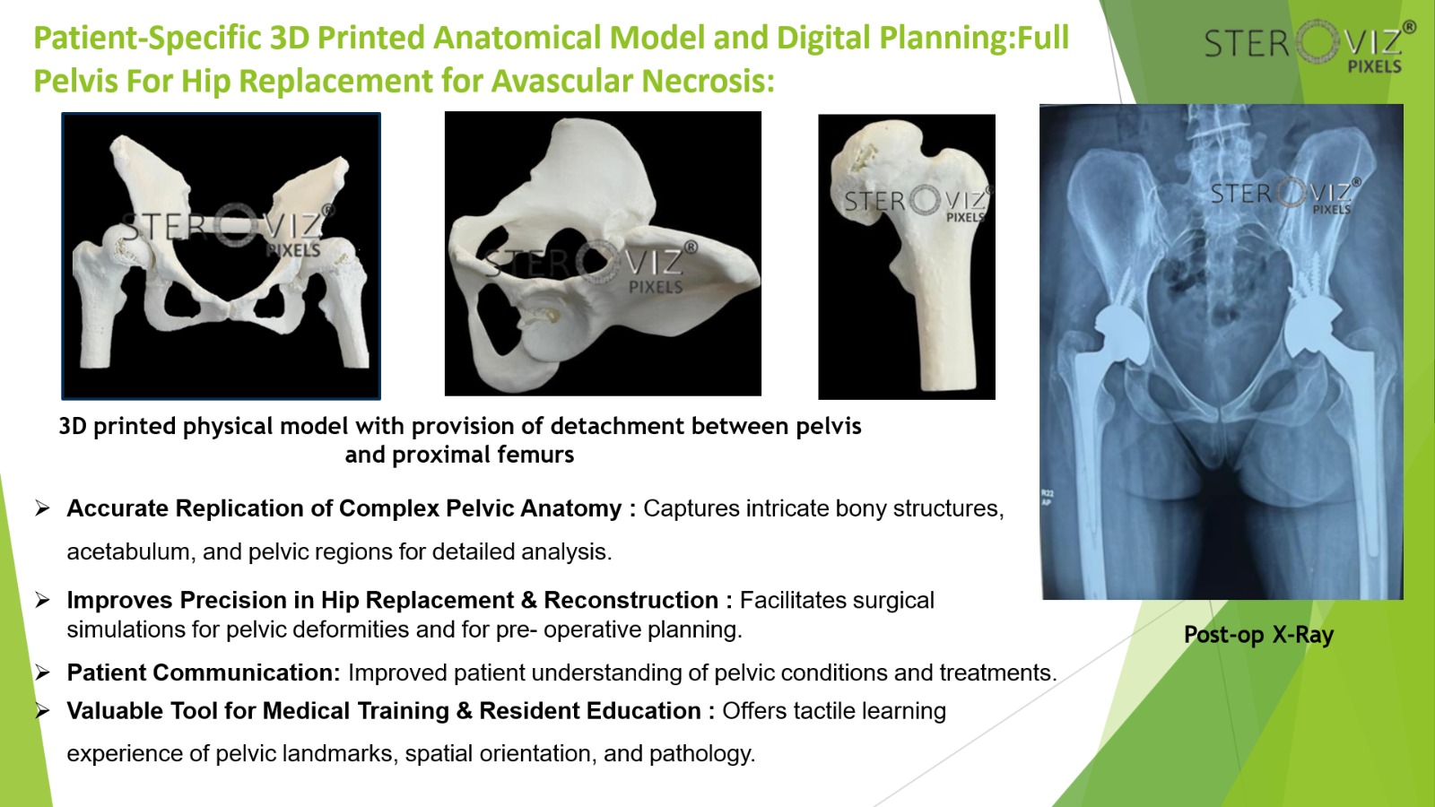 Anatomical Model for Avascular Necrosis