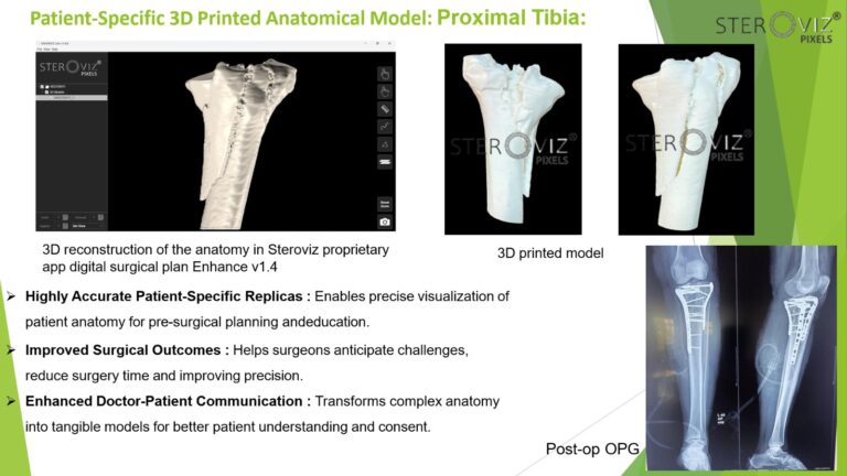 Read more about the article Anatomical Model for Proximal Tibia Fracture