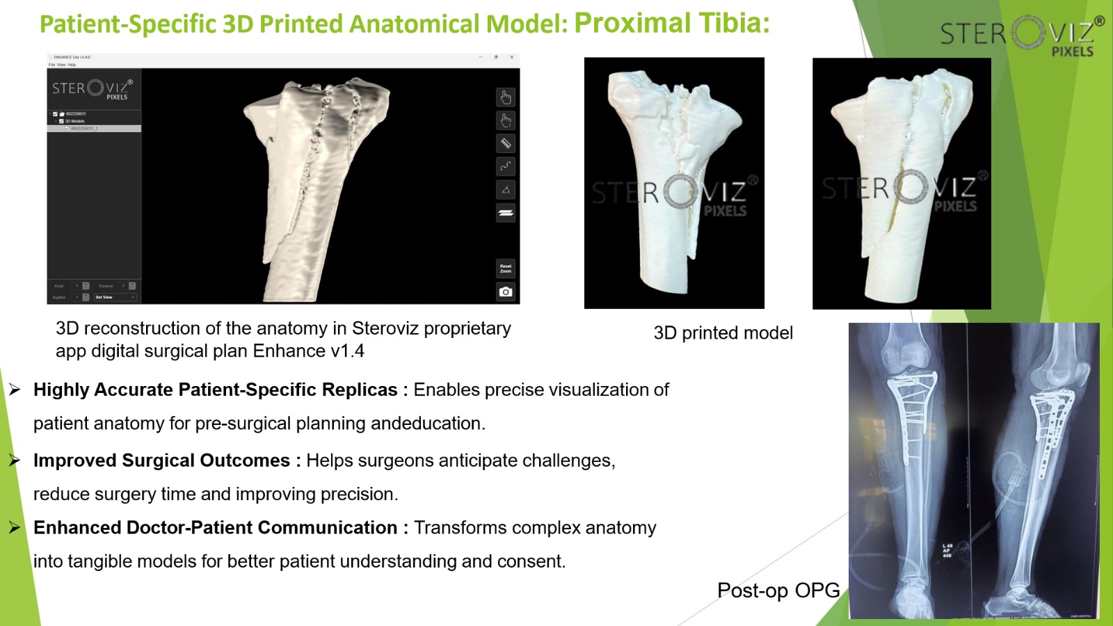 Anatomical Model for Proximal Tibia Fracture