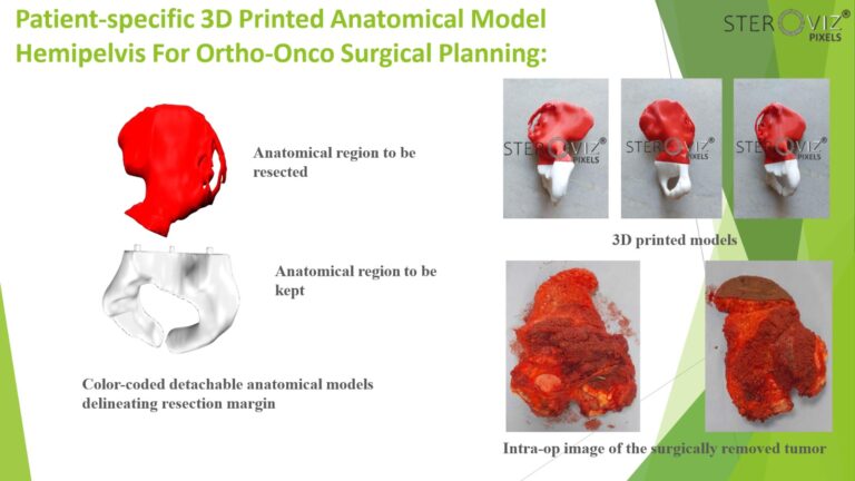 Read more about the article Anatomical Model for Hemipelvic Onco Surgery