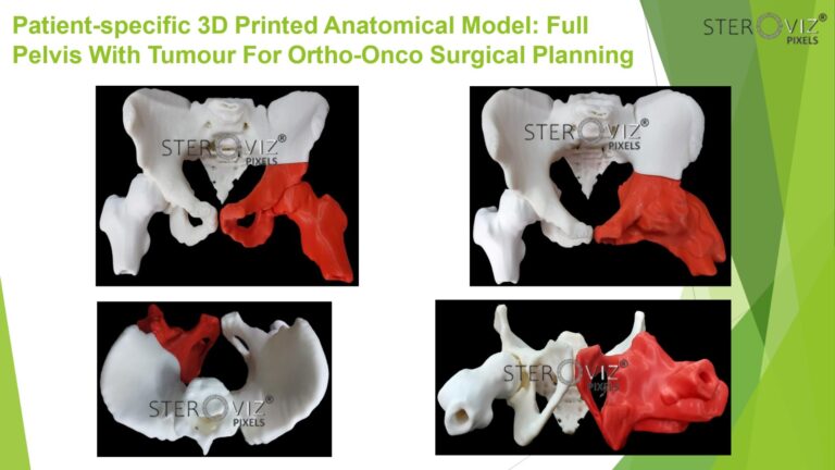 Read more about the article Anatomical Model for Pelvic Onco Surgery