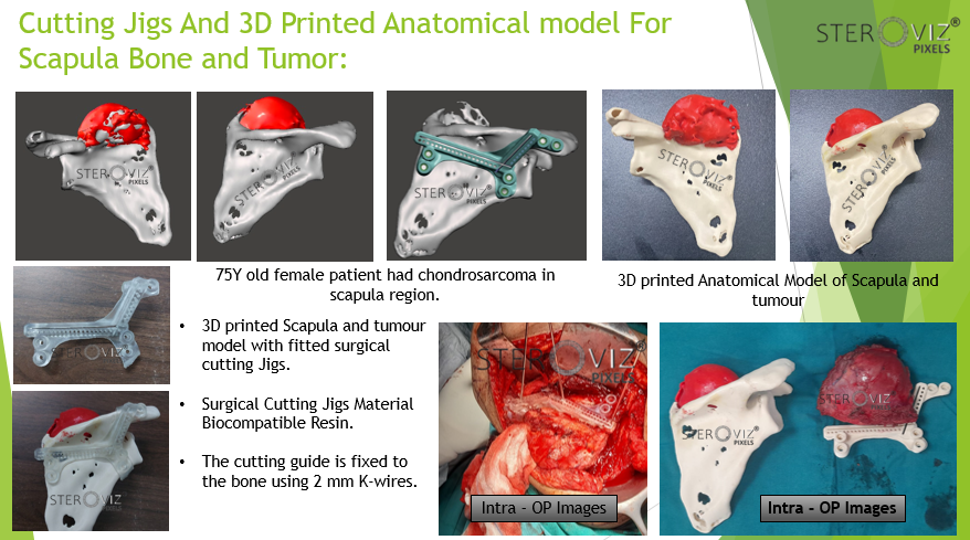 Cutting Jigs and 3D Printed Anatomical Model of Scapula with Tumor