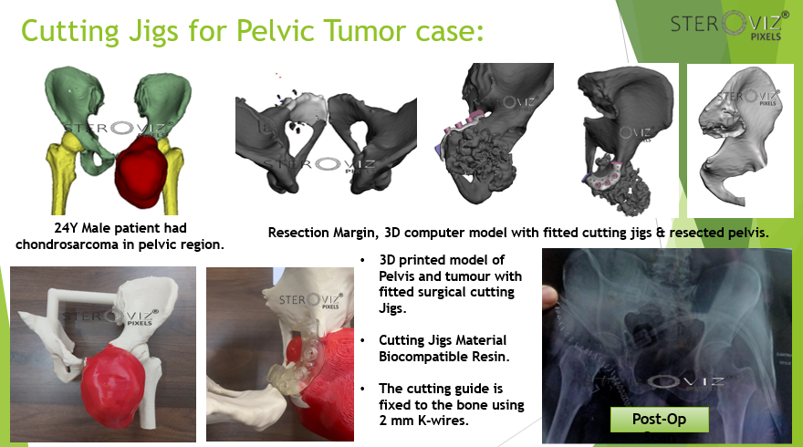 Cutting Jigs and 3D Printed Anatomical Model for Pelvic Tumor