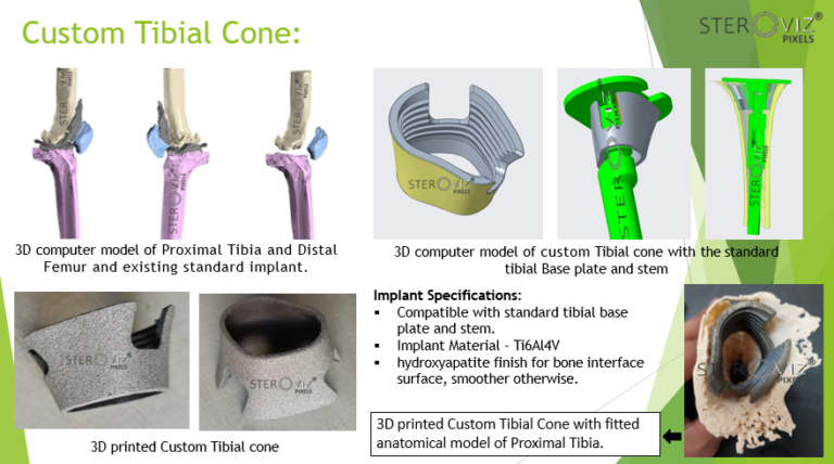 Read more about the article Custom Tibial Cone