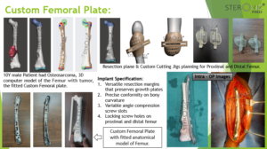 Read more about the article Custom Femoral Plate:
