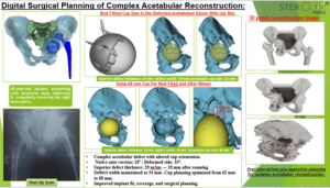 Read more about the article Digital Surgical Planning of Complex Acetabular Reconstruction