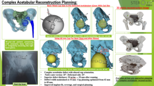 Read more about the article Digital Surgical Planning of Complex Acetabular Reconstruction