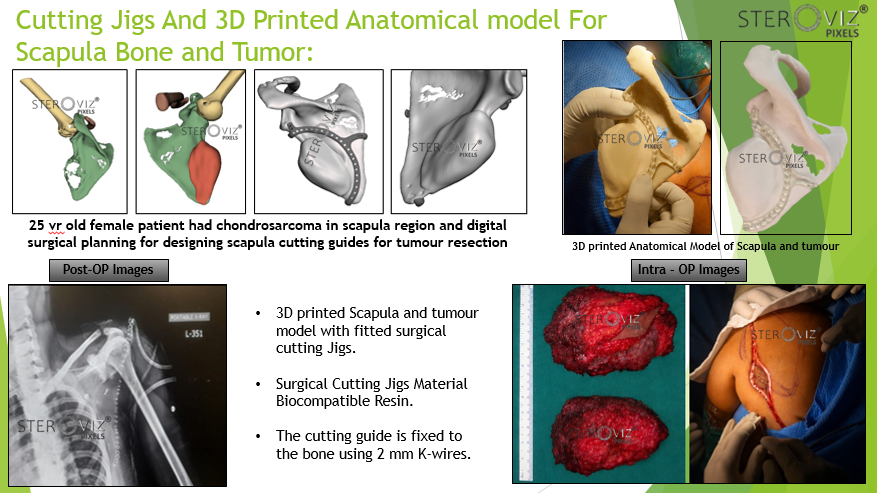 Read more about the article Cutting Jigs and 3D Printed Anatomical Model of Scapula with Tumor