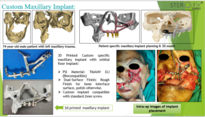 Read more about the article Custom Maxillary Implant..