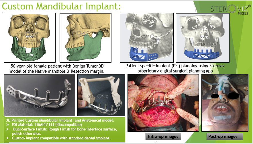 Custom Mandibular Implant.
