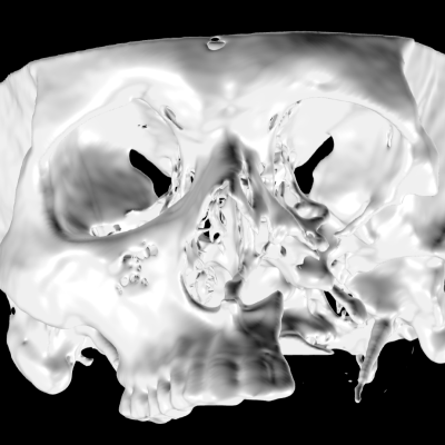 Total maxillectomy on the left side