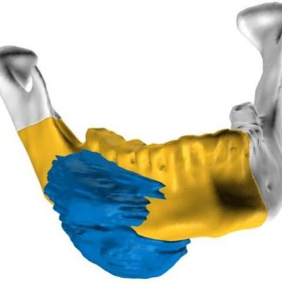 Mirrored mandible(yellow) overlaid between resection cuts of the original mandible(gray)