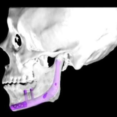 Design of mandibular implants